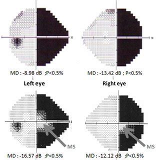 Rehabilitation of homonymous hemianopia: insight into blindsight